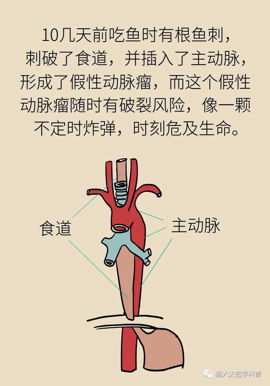 惊险生存考验，鱼刺扎入心脏，丧命式自救