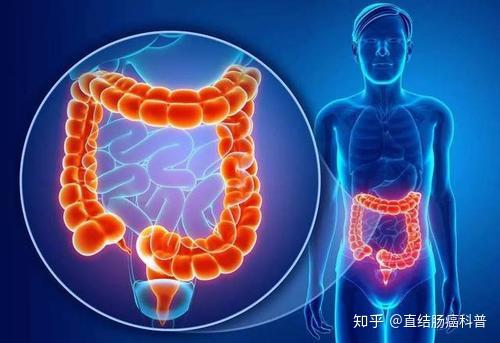 百万粉丝网红咖啡师患直肠癌离世，引发年轻人对直肠癌的深思