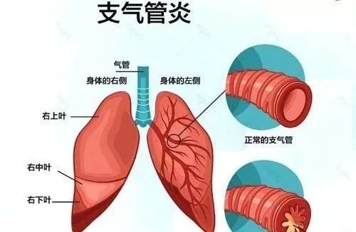 气管炎的症状与表现概述