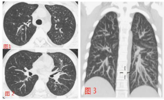 男子甲流后患病毒性肺炎，四肢末端花斑——警示与应对