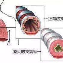 支气管炎详解，影响、防治策略及其严重性探讨