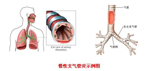 探索支气管炎的最佳治疗策略，高效快速治愈之路