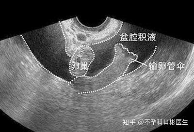 怀孕有盆腔积液对胎儿的影响解析及应对建议