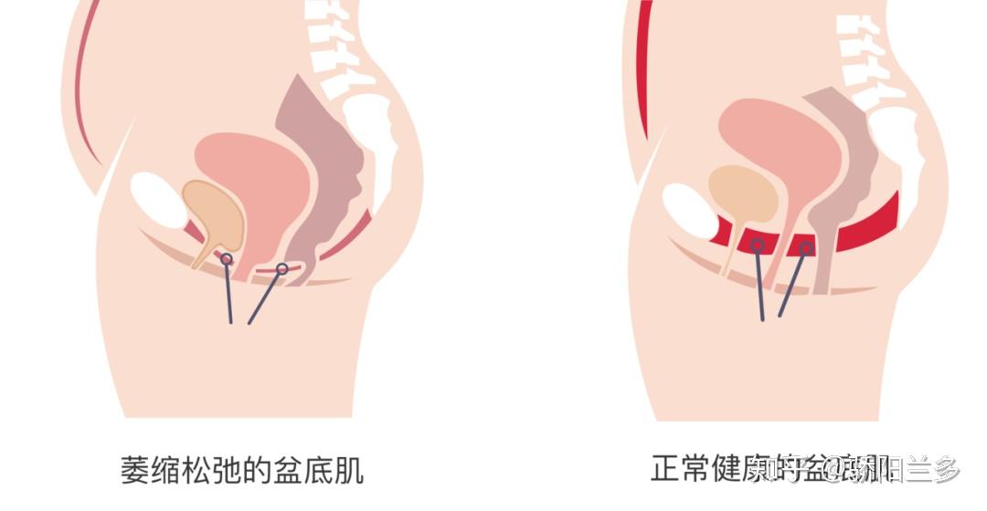 如何应对产后42天复查盆腔积液问题，专业指南与建议