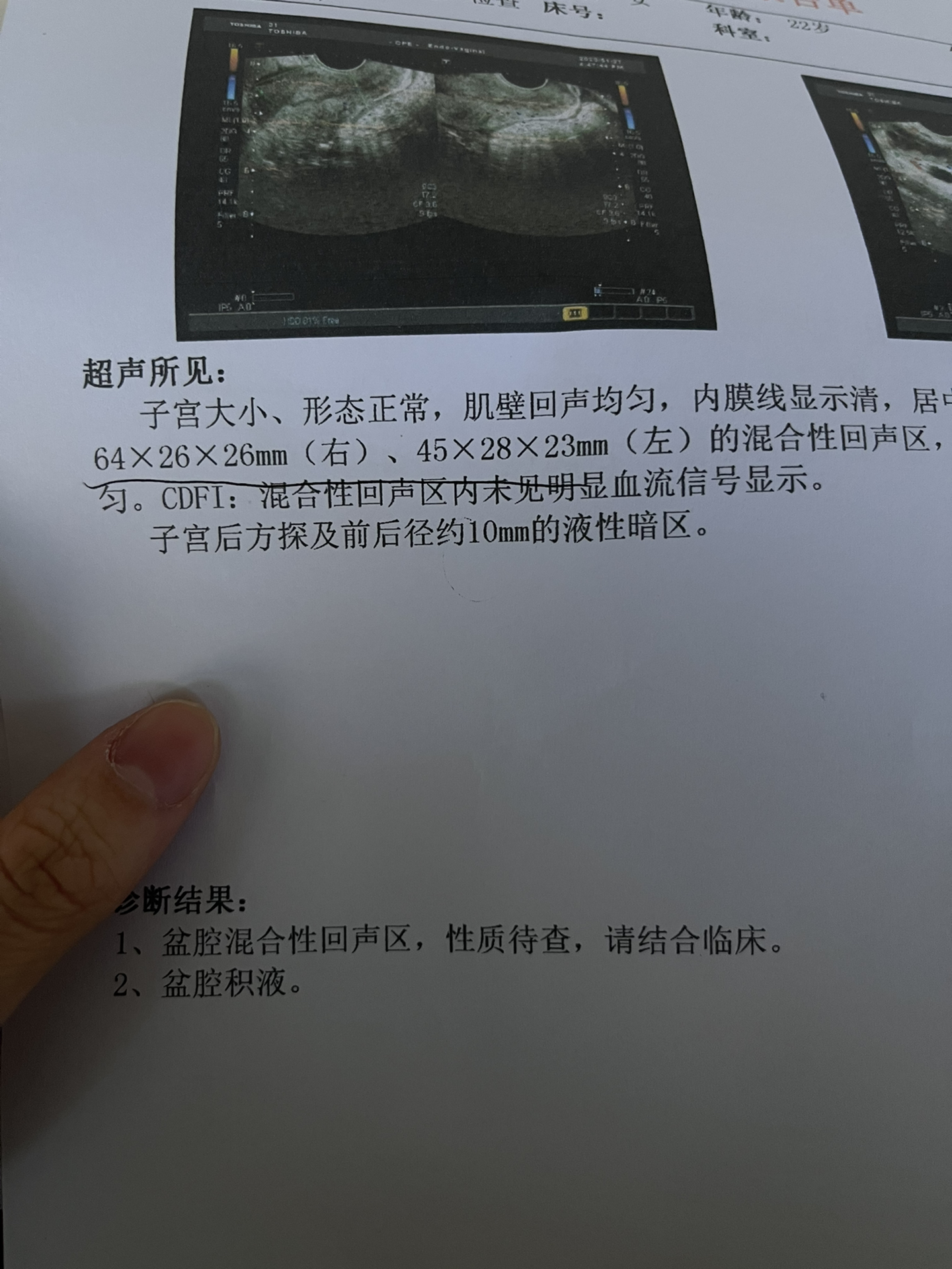 男性盆腔少量积液的治疗方法及其重要性解析