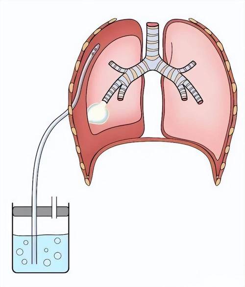 警惕气胸，三类人群需特别关注预防措施