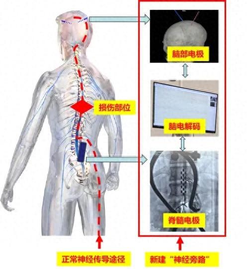 上海截瘫患者成功行走，重塑生活的奇迹奇迹时刻，截瘫患者在上海重新行走，重塑人生希望