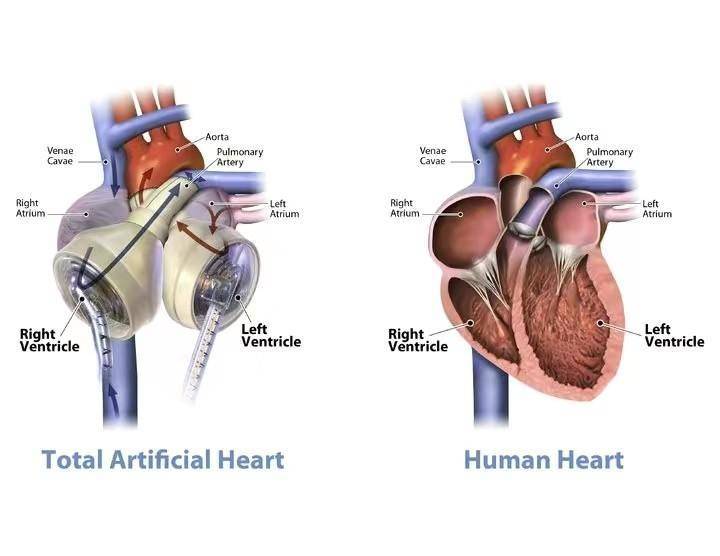 男子依赖机器心脏存活超百日，生命与科技的奇迹时刻
