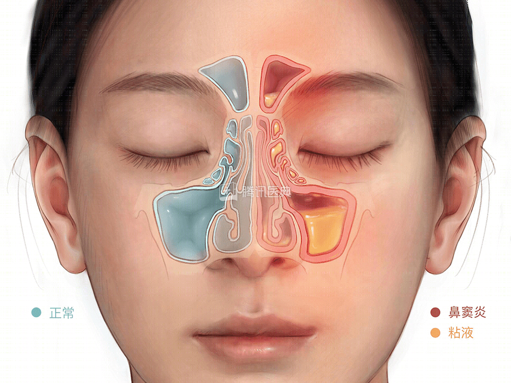 鼻涕颜色是免疫系统的预警
